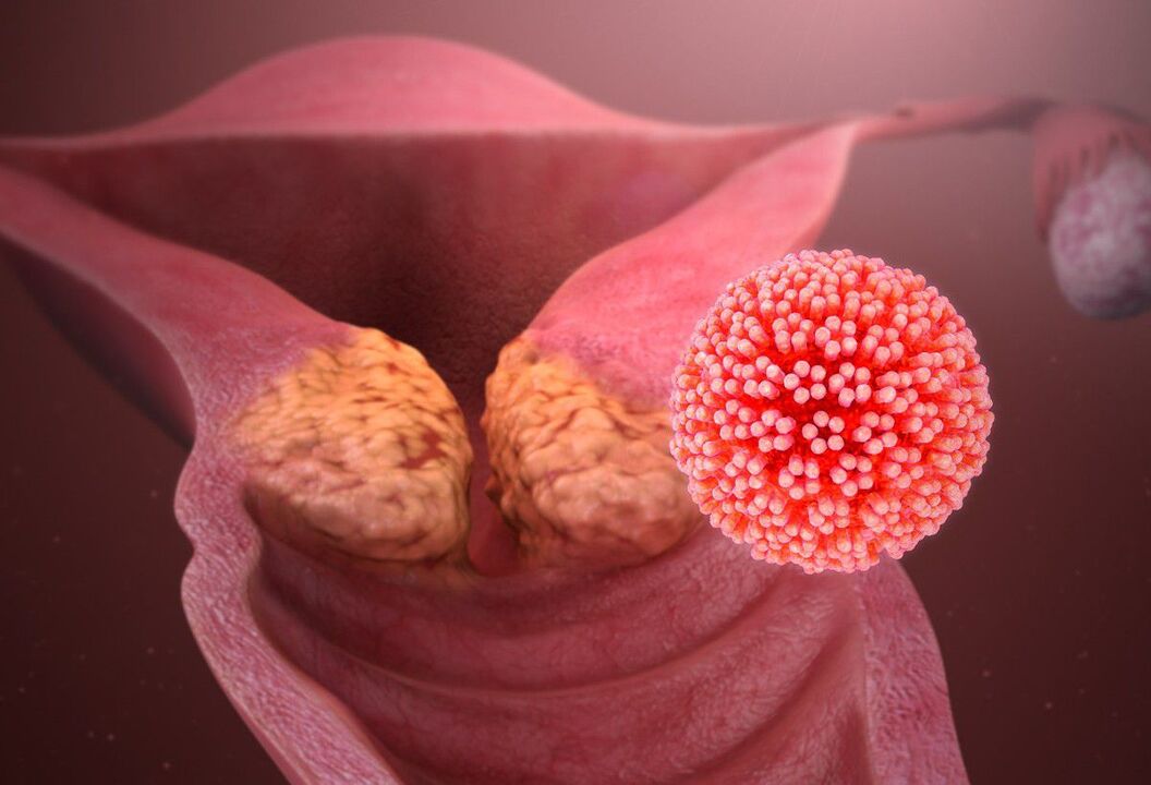 Lesión del cuello uterino por VPH