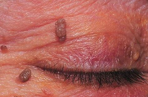 Papilomas en la piel de los párpados que requieren tratamiento. 